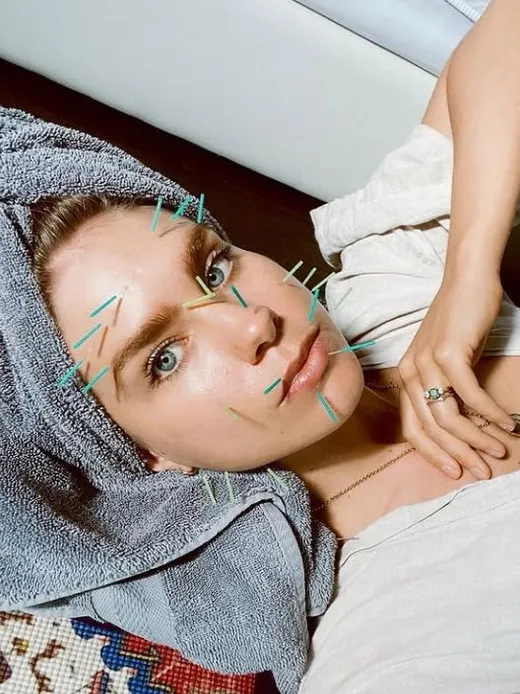 East Meets West: Facial Acupuncture & Whole-Body Beauty
