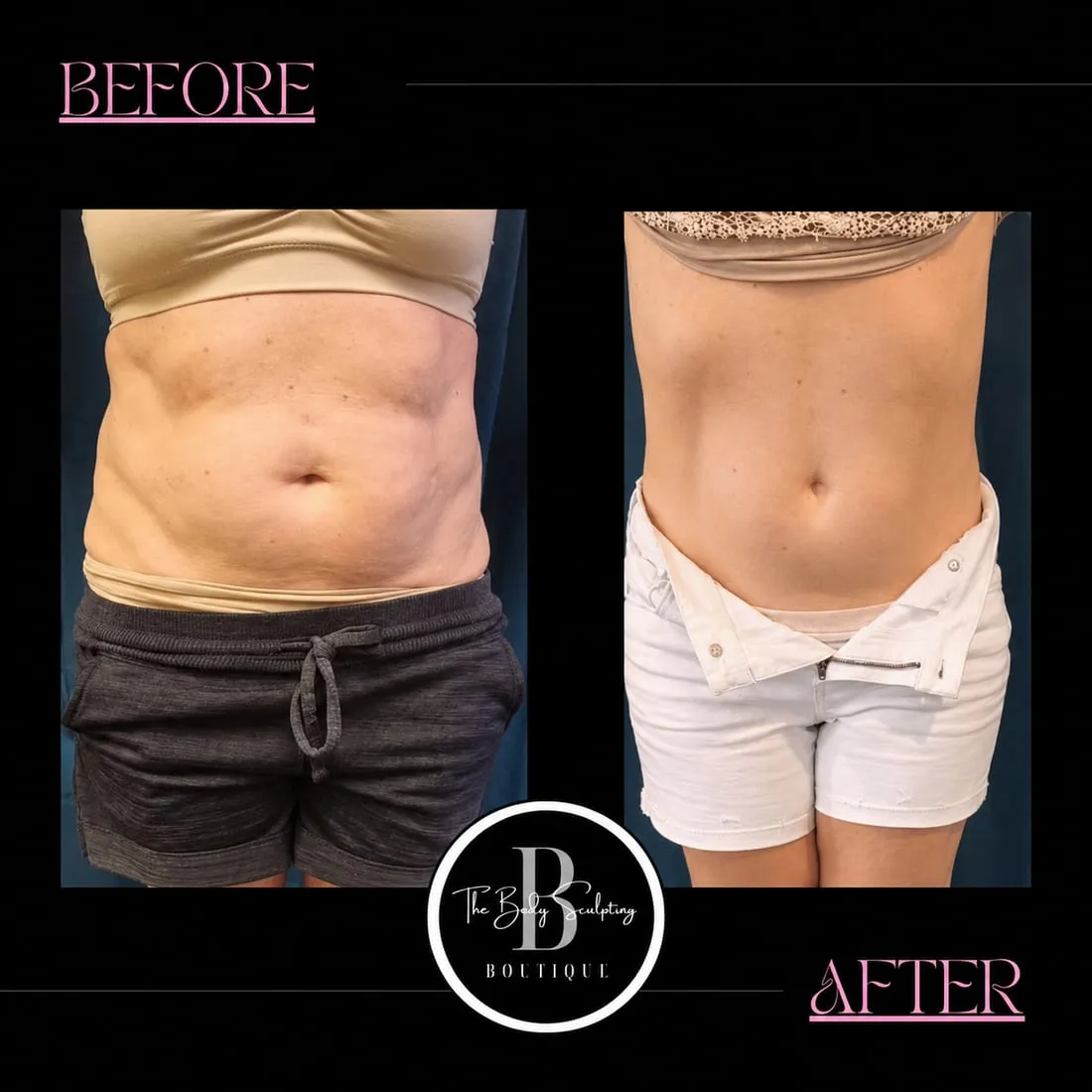 Body contouring · client results, before and after