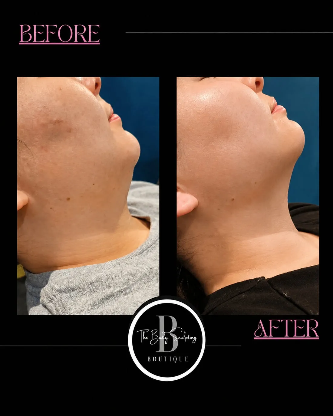 Jawline · client results, before and after